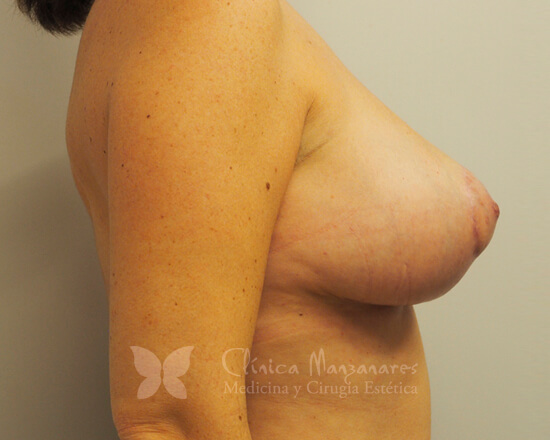Después de cirugía estética reducción de mamas