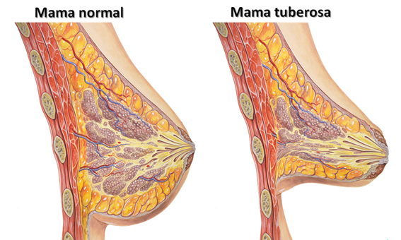 Pecho normal y tuberoso o tubular