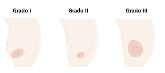 Grados de pechos tubulares